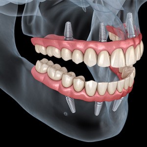 Illustration of implant dentures in Virginia Beach, VA for upper and lower arch