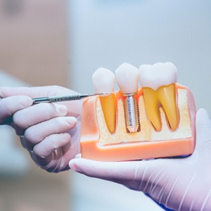Dentist pointing to parts of a dental implant in Virginia Beach