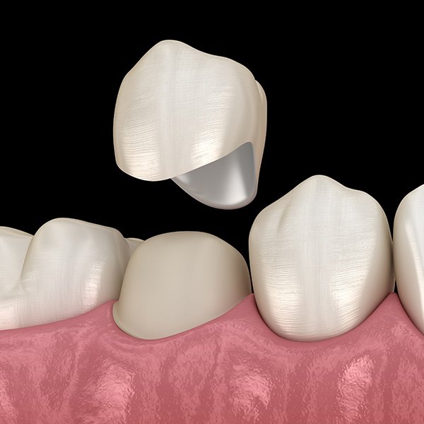 Animated smile during dental crown restorative dentistry