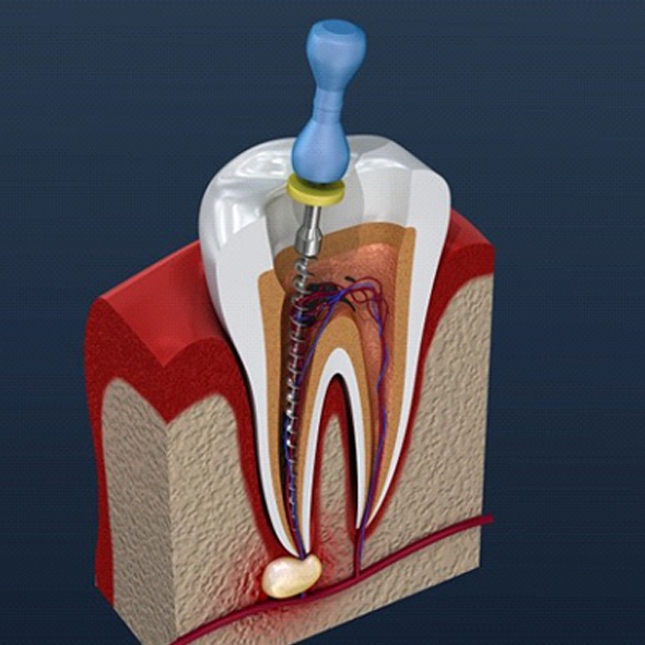 model of a root canal procedure